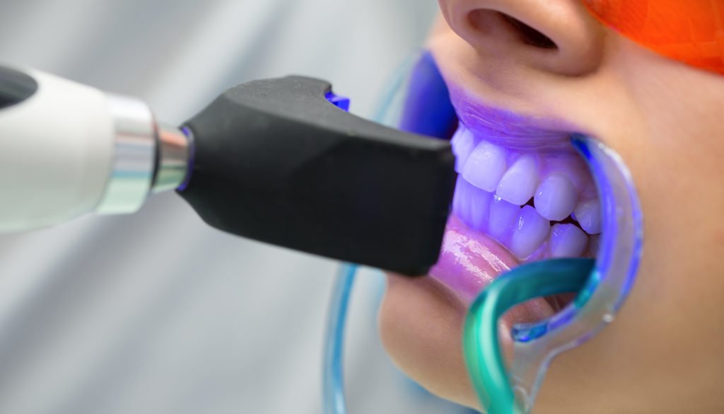 Teeth Whitening in Sydney CBD | Cosmetic Whitening Treatment