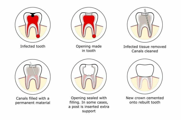 cropped root canal treatment process 1