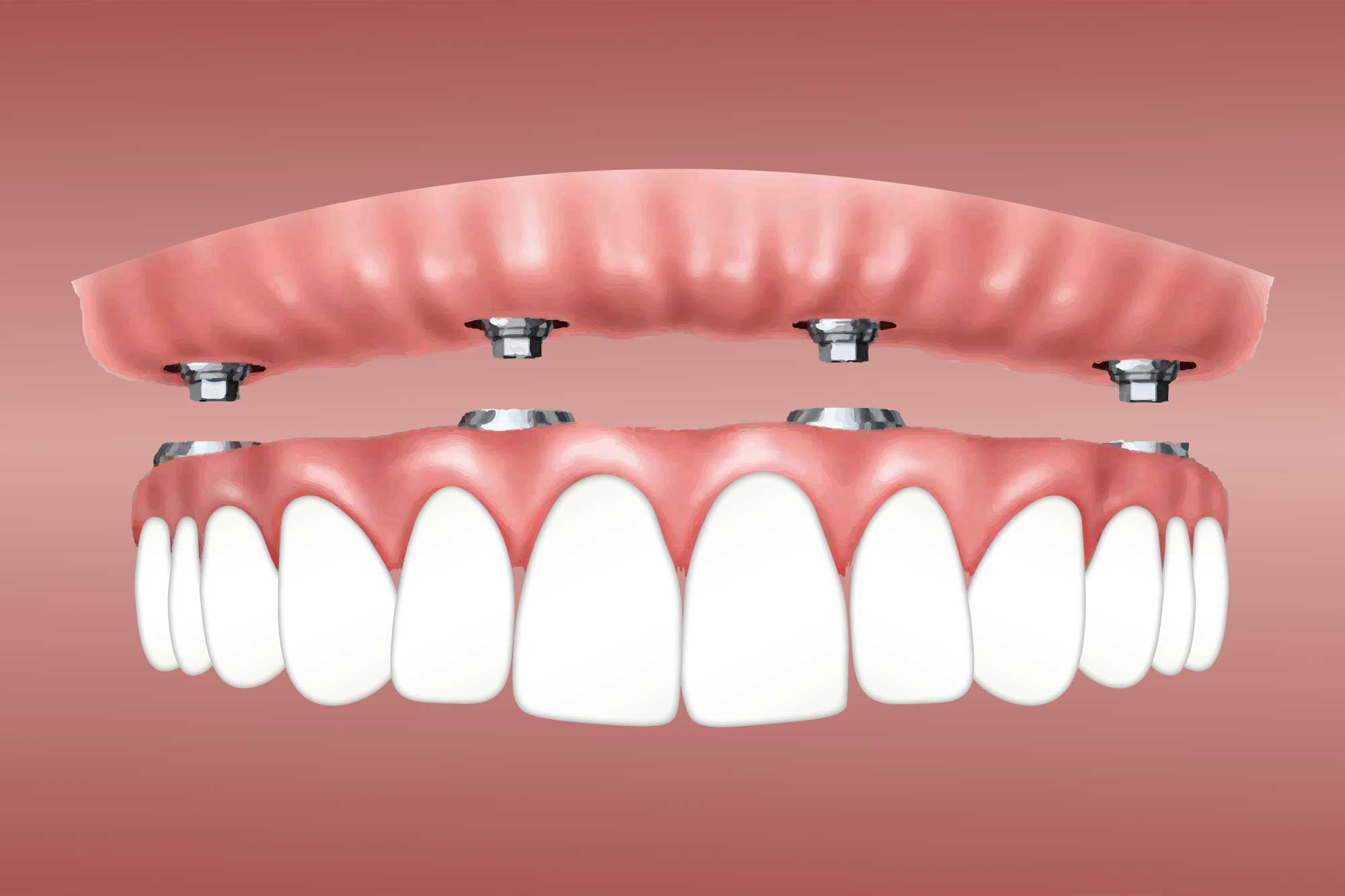 The Truth About Dental Implants: Separating Fact from Fiction on Pain ...