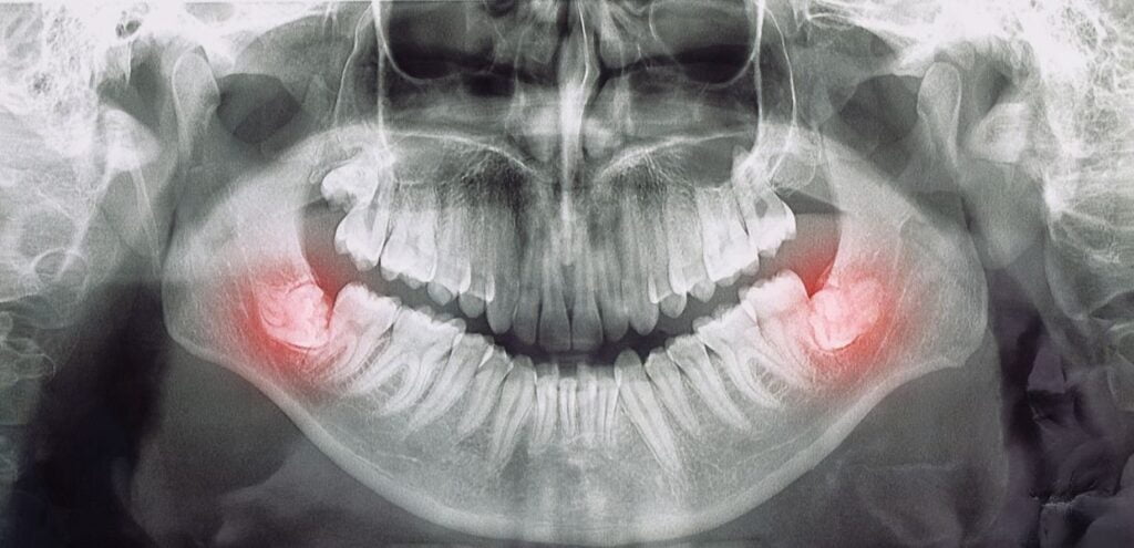 Wisdom Teeth Removal