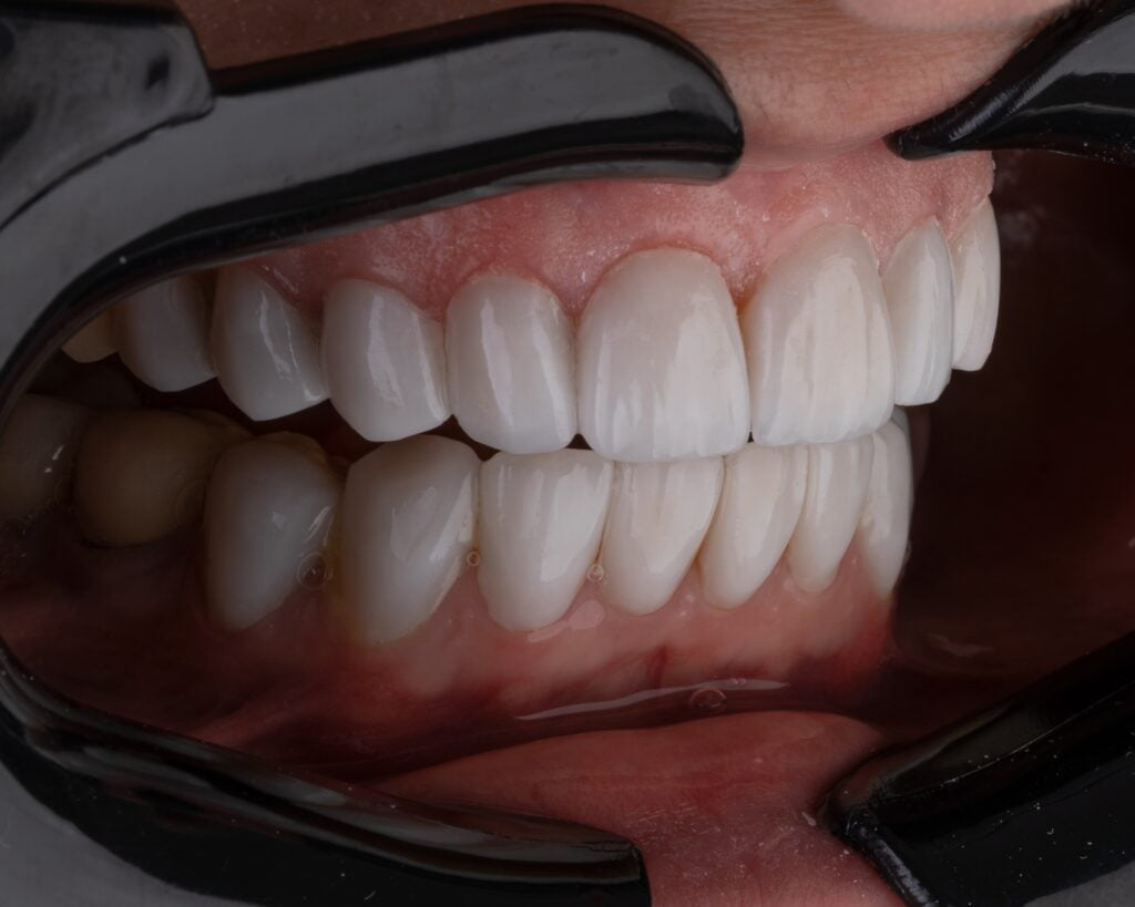 Teeth Extraction