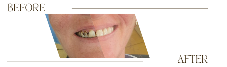 before and after prudential dental