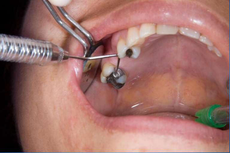 Root Canal Sydney CBD