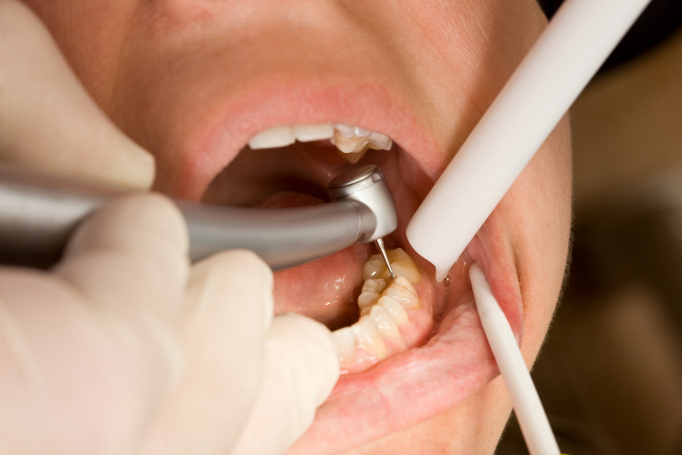 Root Canal Treatment