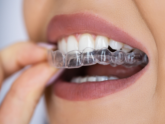 Orthodontic Clear Aligners