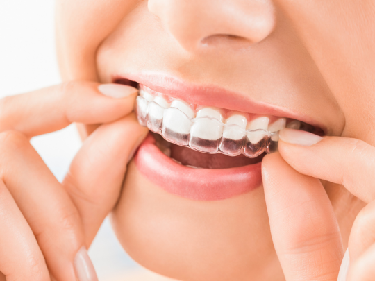 Clear Aligners