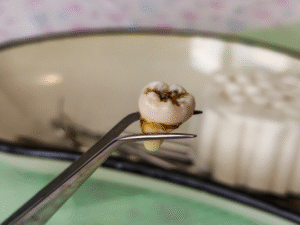 Wisdom Tooth Removal