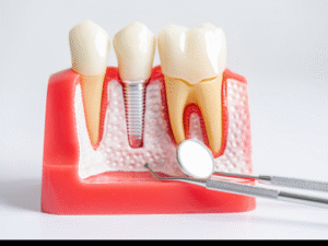 Root Canal Treatment