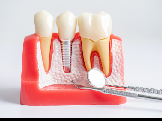 Root Canal Treatment