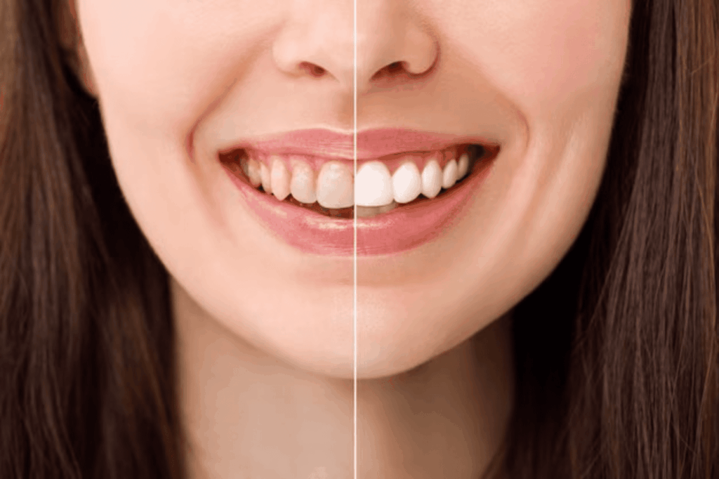 Teeth Whitening Sydney