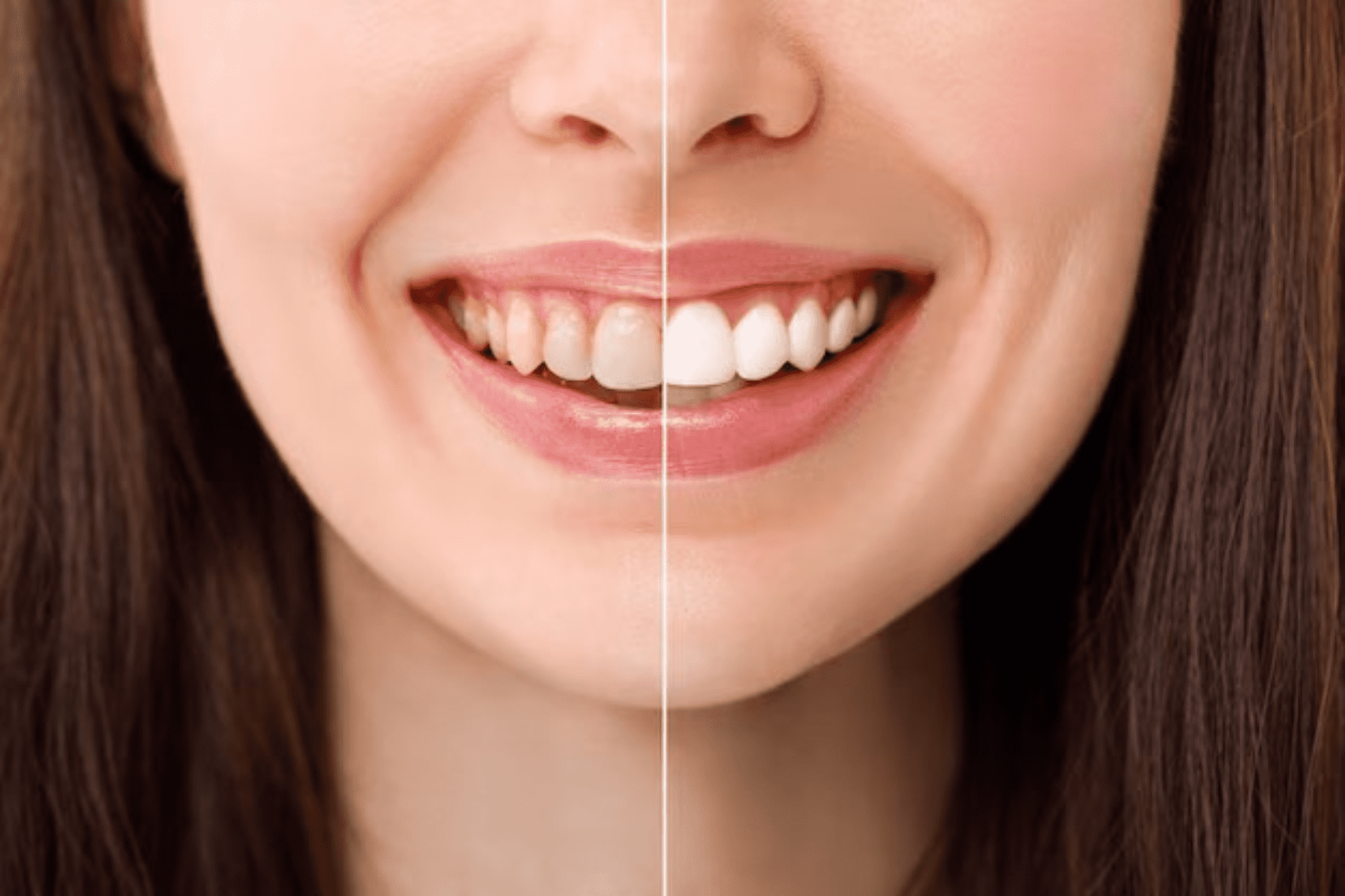 Teeth Whitening Sydney